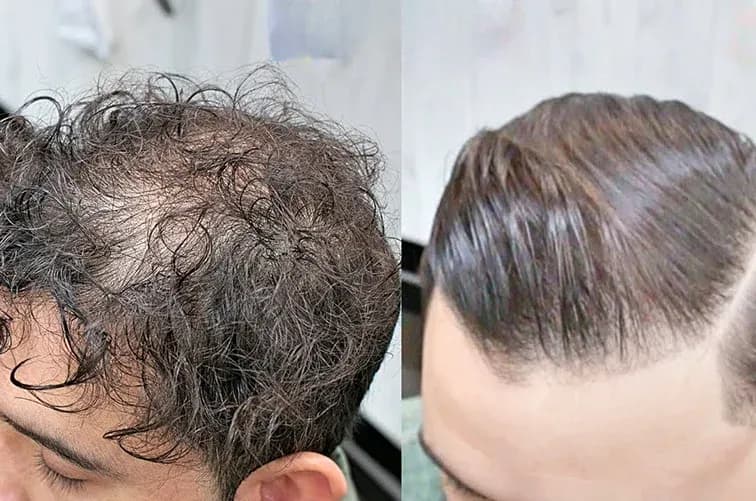 Keratin Bakımı
